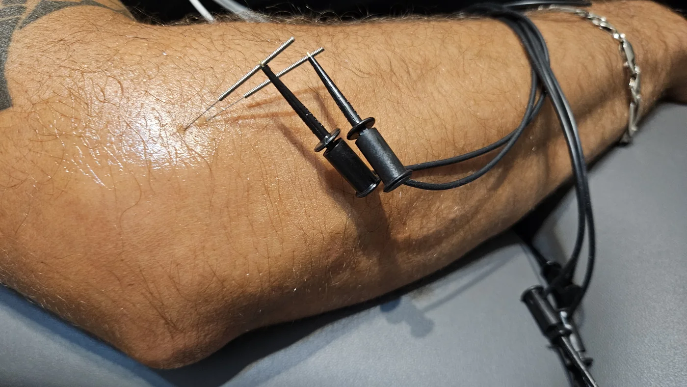 Przezskórna neuromodulacja w obrębie kolana